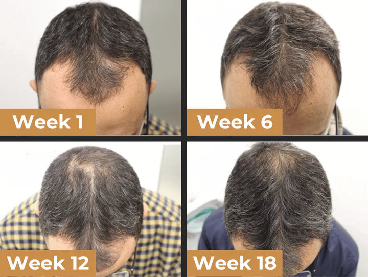 SUMMER Sale Countdown!⏰DIYSTAR™Root Activator Shampoo- Regain a full head of hair in just 6 weeks!